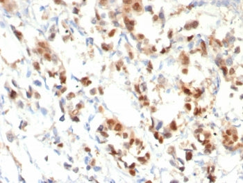 IHC staining of FFPE human breast cancer with PR antibody (clone PGR/8099R). HIER: boil tissue secti
