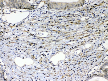 IHC testing of FFPE human intestinal cancer tissue with VEGFR2 antibody at 1ug/ml. Required HIER: st