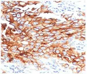 IHC testing of FFPE human lung mesothelioma with MSLN antibody (clone MKPF-1). HIER: boil tissue sec