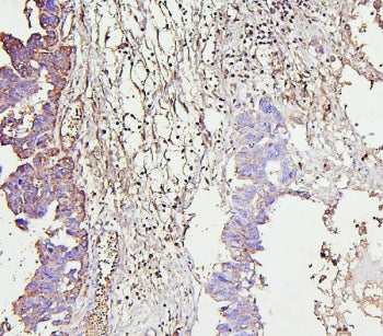 IHC staining of FFPE human ovarian cancer with IRAK1 antibody. HIER: boil tissue sections in pH6, 10