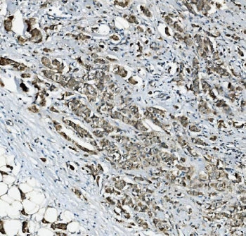 IHC staining of FFPE human breast cancer with RAB1B antibody. HIER: boil tissue sections in pH8 EDTA