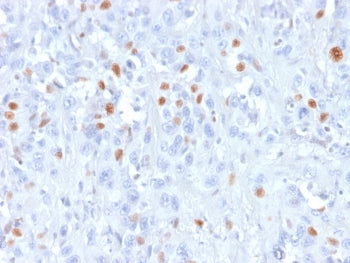IHC testing of human urothelial carcinoma with recombinant p21 antibody (rCIP1/823). Required HIER: 