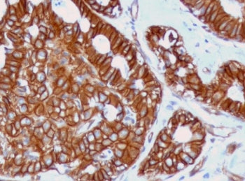 IHC staining of FFPE human breast cancer tissue with recombinant beta Catenin antibody (clone CTNB1-