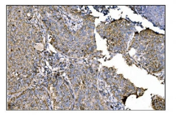 IHC staining of FFPE human lung cancer tissue with Ornithine Aminotransferase antibody. HIER: boil t