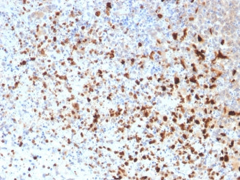 IHC staining of FFPE human cervix with HSV1 antibody (clone 10A3). Required HIER: boil tissue sectio