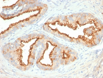IHC staining of FFPE human prostate carcinoma with CD10 antibody (clone MME/2579). HIER: boil tissue