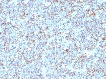 IHC: Formalin-fixed, paraffin-embedded human Ewing's sarcoma stained with anti-CD99 antibody (SPM596