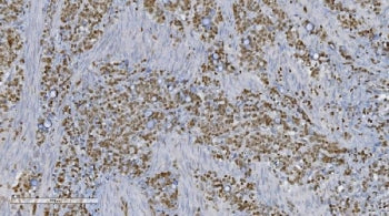 IHC staining of FFPE human gastric cancer tissue with Aryl hydrocarbon Receptor antibody. HIER: boil