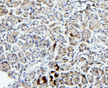 IHC staining of FFPE human pancreatic cancer with TRPV5 antibody. HIER: boil tissue sections in pH6,