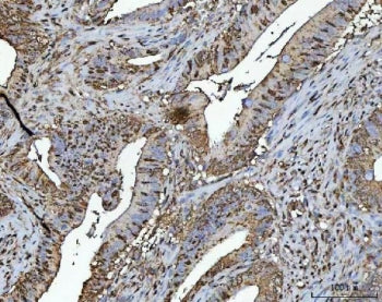 IHC staining of FFPE human colorectal adenocarcinoma tissue with TR4 antibody. HIER: boil tissue sec