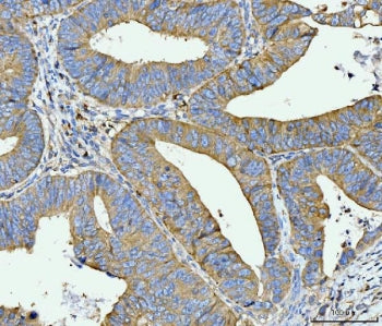IHC staining of FFPE moderately differentiated adenocarcinoma of human rectum tissue with ACSL4 anti