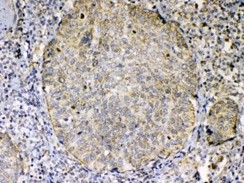 IHC testing of FFPE human lung cancer tissue with TNFSF18 antibody at 1ug/ml. Required HIER: steam s
