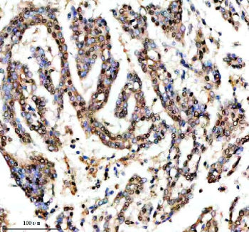 IHC staining of FFPE human lung cancer tissue with SHP2 antibody, HRP-secondary and DAB substrate. H