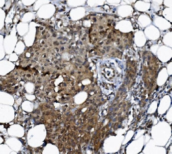 IHC staining of FFPE human breast cancer tissue with DCTN1 antibody. HIER: boil tissue sections in p