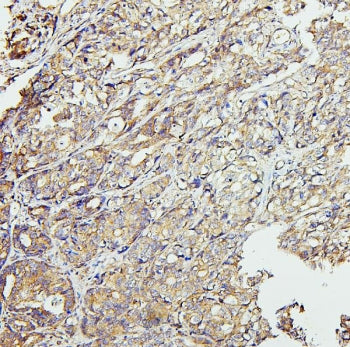 IHC staining of FFPE human stomach cancer with CETP antibody. HIER: boil tissue sections in pH6, 10m