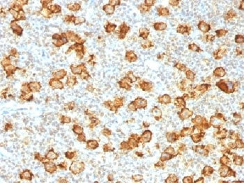 IHC testing of FFPE human Hodgkin's lymphoma stained with recombinant CD30 antibody (clone Ki-1/1505
