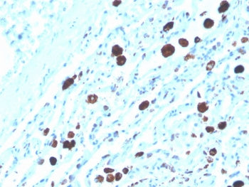 IHC staining of FFPE human lung adenocarcinoma with biotin-conjugated Napsin A antibody (clone NAPSA