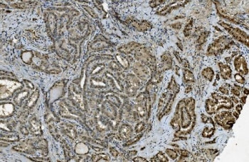 IHC staining of FFPE human thyroid cancer with TKT antibody. HIER: boil tissue sections in pH8 EDTA 