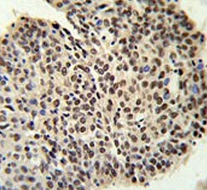 IHC testing of FFPE human lung carcinoma tissue with PRP19 antibody. HIER: steam section in pH6 citr