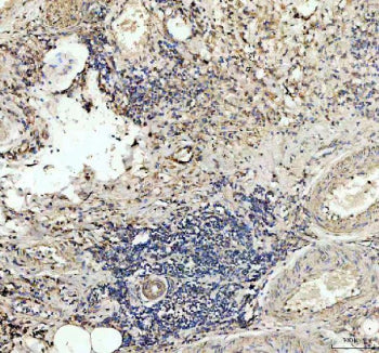 IHC staining of FFPE human lung cancer tissue with TSPAN12 antibody, HRP-labeled secondary and DAB s