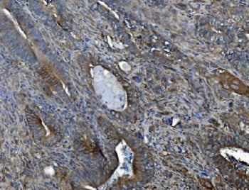 IHC staining of FFPE human gallbladder adenocarcinoma tissue with ACVRL1 antibody. HIER: boil tissue