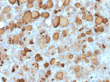 IHC: Formalin-fixed, paraffin-embedded human thyroid carcinoma stained with recombinant TG antibody 