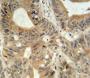 ABCC3 antibody immunohistochemistry analysis in formalin fixed and paraffin embedded human colon car