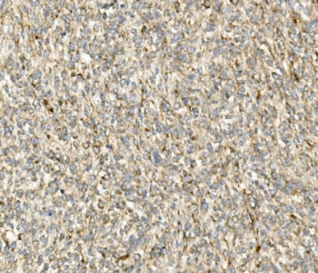 IHC staining of FFPE human renal cancer with CHOP antibody. HIER: boil tissue sections in pH8 EDTA f