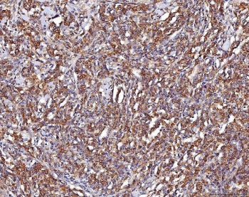 IHC staining of FFPE human lymphoma tissue with ENO1 antibody. HIER: boil tissue sections in pH8 EDT