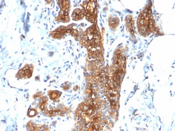 IHC testing of FFPE human breast carcinoma with recombinant Mucin-1 antibody (clone MUC1/2278R). Req