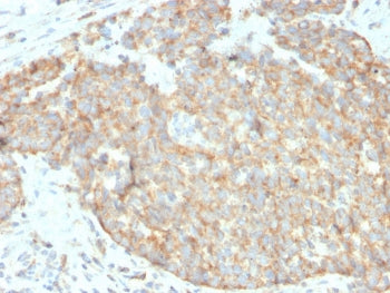 IHC staining of FFPE human breast carcinoma with DR5 antibody. HIER: boil tissue sections in pH 9 10