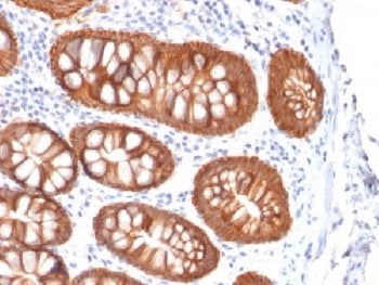 IHC testing of colon carcinoma with recombinant Ep-CAM antibody (clone rVU-1D9). Required HIER: boil