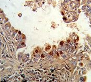 IHC testing of FFPE human lung carcinoma tissue with PKC alpha antibody. HIER: steam section in pH6 