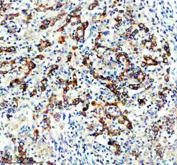 IHC staining of FFPE human stomach cancer tissue with DGAT1 antibody, HRP-secondary and DAB substrat