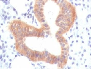 IHC testing of FFPE human melanoma with CD86 antibody (clone CDLA86). Staining of formalin-fixed tis