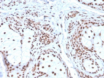 IHC staining of FFPE human basal cell carcinoma with Nucleophosmin antibody (clone NPM1/3286). HIER: