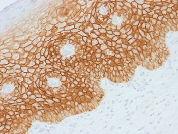 IHC testing of FFPE human cervical squamos cell carcinoma with CD44v4 antibody. Required HIER: steam