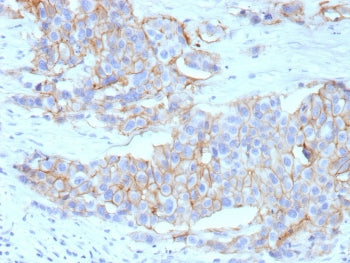IHC staining of FFPE human breast cancer tissue with recombinant HER-2 antibody (clone ERBB2/13055R)