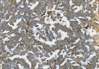 IHC staining of FFPE human ovarian cancer with K-Cadherin antibody. HIER: boil tissue sections in pH