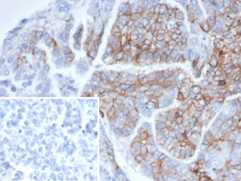 IHC staining of FFPE human ovarian cancer tissue with CD56 antibody (clone NCAM1/6715). Inset: PBS u