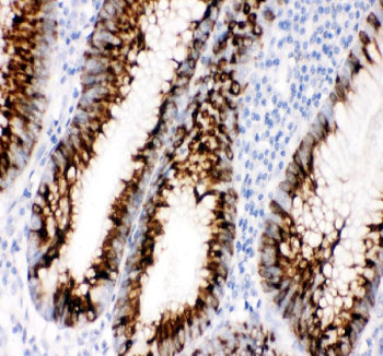 IHC staining of FFPE human colon cancer tissue with CCL11 antibody, HRP-secondary and DAB substrate.