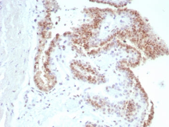 IHC staining of FFPE human prostate carcinoma tissue with Androgen Receptor antibody (clone rDHTR/88