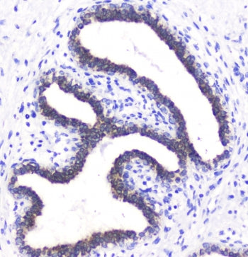IHC staining of FFPE human breast cancer with BTC antibody at 1ug/ml. HIER: boil tissue sections in 
