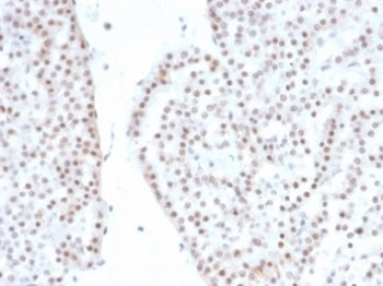 IHC staining of FFPE human renal oncocytoma with recombinant SF-1 antibody (clone NR5A1/4368R). HIER: boil tissue sections in pH 9 10mM Tris with 1mM EDTA for 20 min and allow to cool before testing.