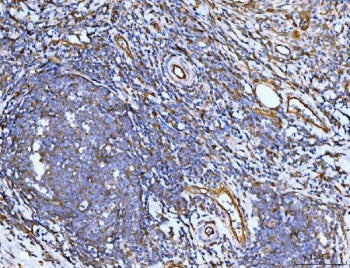 IHC staining of FFPE human lymph node metastases in rectal cancer tissue with Filamin B antibody. HI