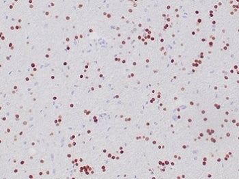 IHC staining of FFPE human oligodendroglioma tissue with recombinant OLIG2 antibody (clone OLIG2/6695R). HIER: boil tissue sections in pH 9 10mM Tris with 1mM EDTA for 20 min and allow to cool before testing.