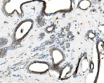 IHC staining of FFPE human breast cancer with PRKG1 antibody. HIER: boil tissue sections in pH8 EDTA