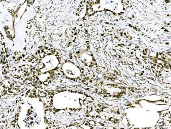 IHC staining of FFPE human stomach cancer tissue with GRHL2 antibody. HIER: boil tissue sections in 