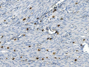 IHC staining of FFPE human endometrial carcinoma with TNFRSF8 antibody. HIER: boil tissue sections i