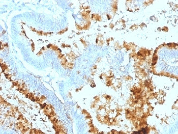 IHC: Formalin-fixed, paraffin-embedded human colon carcinoma stained with Blood Group Lewis a antibo